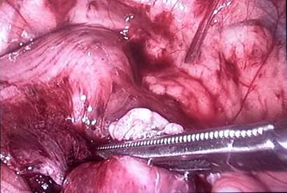 گروه زنان و زایمان _ لاپاراسکوپی